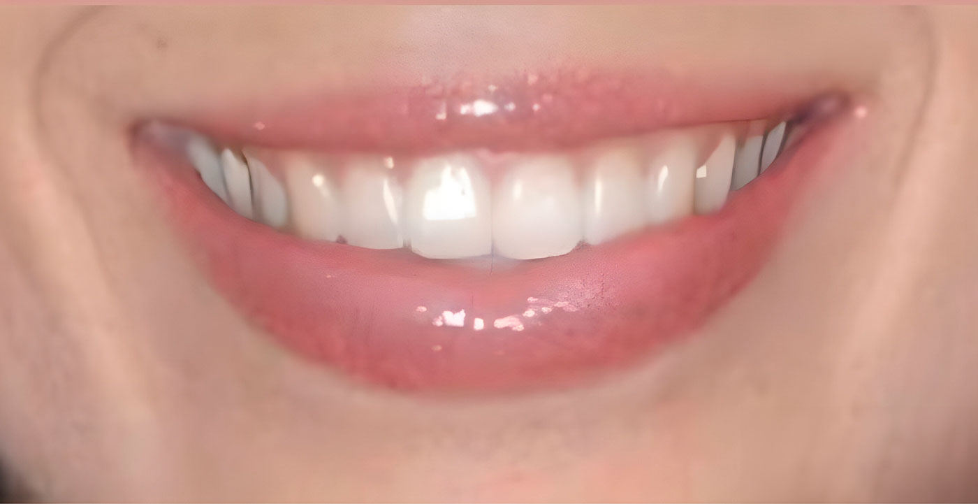 despues1